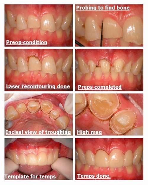 Laser troughiing for crowns.edited.jpg